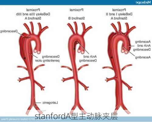 stanfordA型主动脉夹层