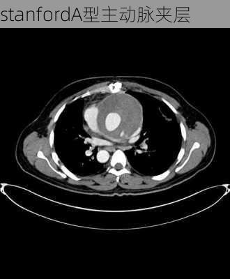 stanfordA型主动脉夹层