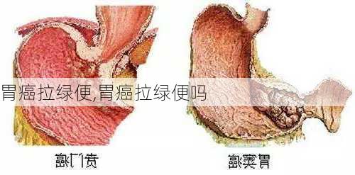 胃癌拉绿便,胃癌拉绿便吗